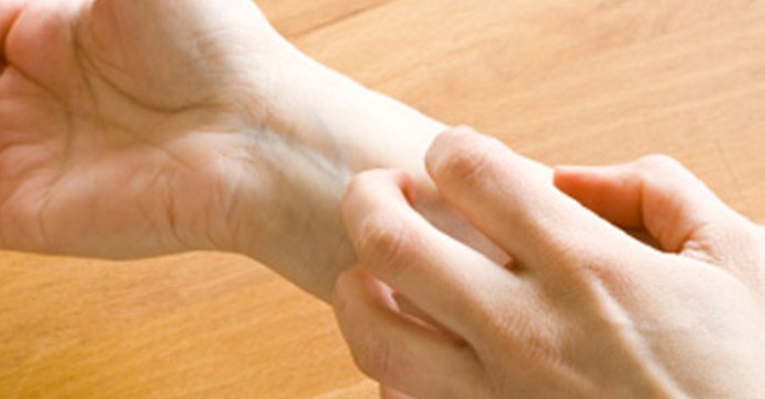 Kako se znebiti ekcema?