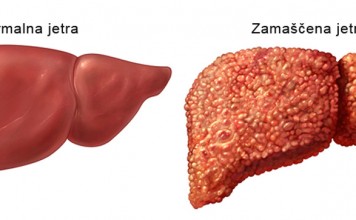 DETOX: Zamaščena jetra?