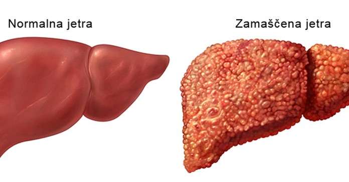 DETOX: Zamaščena jetra?