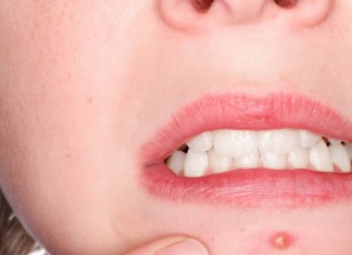 S konopljinim oljem v boj proti aknam!