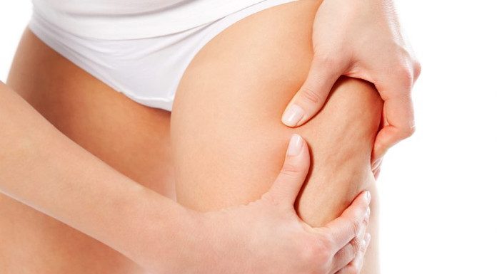 Raziskave kažejo: Pomarančasto kožo ima kar 80% žensk